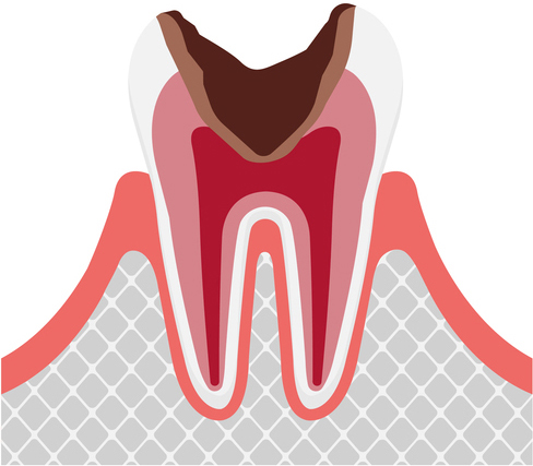 C3（歯髄の虫歯）