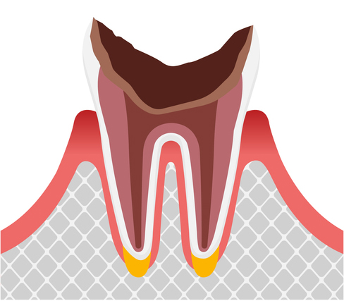 C4（歯周組織の虫歯）
