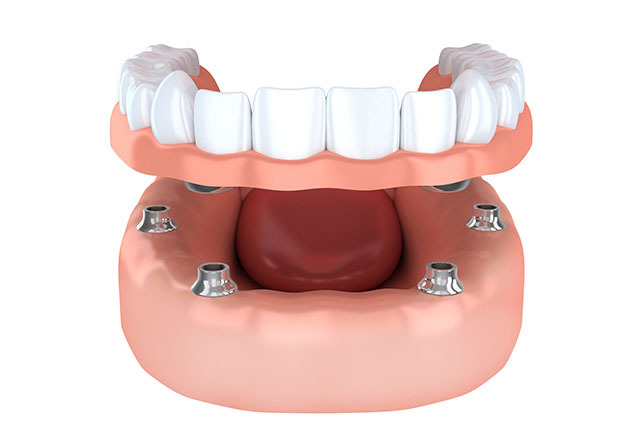 入れ歯とインプラントの性能「インプラントオーバーデンチャー」